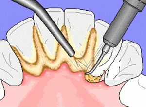 scaling-dental-tartar-and-plaque-300x219.jpg